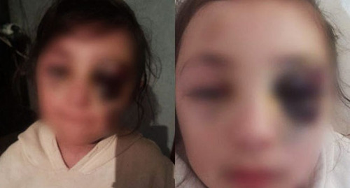 Девочка, получившая травму лица в школе. Фото: https://media.az/society/1067937627/mat-poluchivshey-v-shkole-travmu-uchenicy-oni-dazhe-ne-prilozhili-led-k-gematome-video/