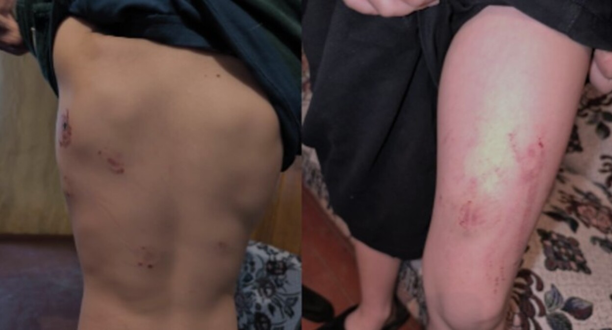 Травмы, нанесенные ребенку родственниками в Самегрело. Скриншот из репортажа TV Pirveli