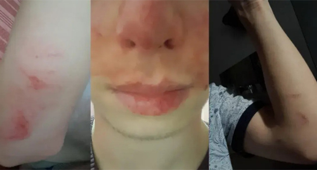 Следы побоев у подростка. Скриншот видео "Кавказского узла" https://www.instagram.com/p/DLo13qas84B/ принадлежит компании Meta деятельность которой запрещена в России